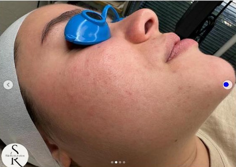 Client skin after acne treatment — significantly cleared