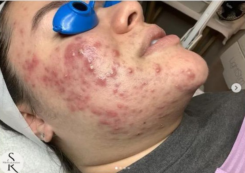 Client skin before acne treatment — moderate to severe acne